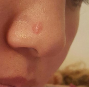 วิธีการแก้ไขรอยแผลเป็นคีลอยด์หลังการผ่าตัดเสริมจมูก