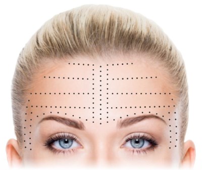 Biorevitalization ในช่วงฤดูร้อน - เป็นไปได้หรือไม่? กฎและข้อห้าม