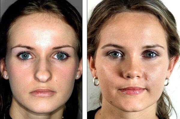 วิธีการแก้ไขรอยแผลเป็นคีลอยด์หลังการผ่าตัดเสริมจมูก