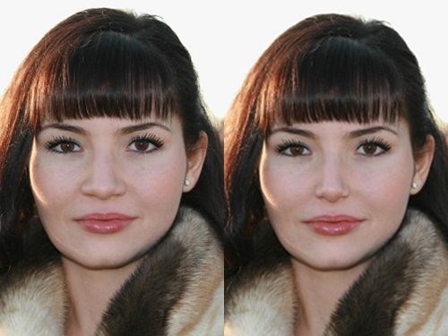 วิธีการแก้ไขรอยแผลเป็นคีลอยด์หลังการผ่าตัดเสริมจมูก