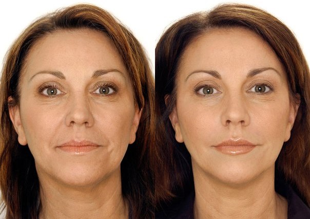 Biorévitalisation du visage. Techniques, étapes du cours, caractéristiques de la procédure