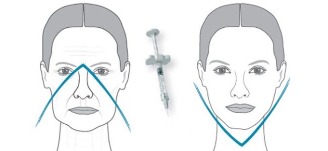 Injections d'acide hyaluronique pour le visage (lèvres, sous les yeux, front). Photos avant et après
