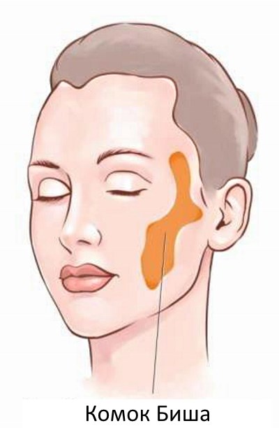 Morceaux de Bisha. Qu'est-ce que c'est, comment est-il enlevé, une opération, comment le nettoyer à la maison