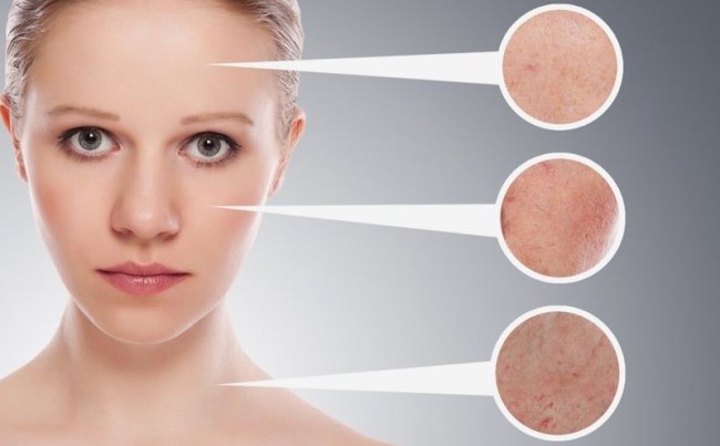 Mésothérapie faciale - qu'est-ce que c'est. Photos avant et après, avis, à quel âge