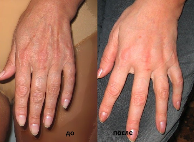 Qu'est-ce que le lipofilling? Lipofilling du visage, seins, fesses, prix, photos avant et après