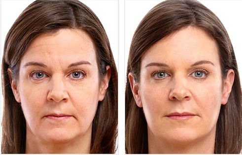 Dysport - qu'est-ce que c'est, la procédure, les injections dans le front, entre les sourcils des rides. Résultats, photo