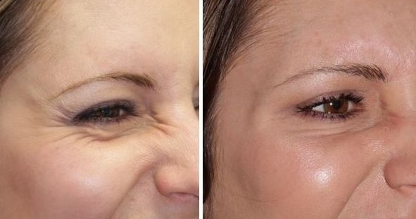 Dysport - qu'est-ce que c'est, la procédure, les injections sur le front, entre les sourcils des rides. Résultats, photo