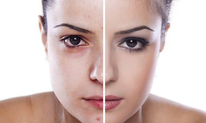 การปอกเปลือกไกลโคลิก - มันคืออะไรประโยชน์สำหรับใบหน้าวิธีทำที่บ้านภาพถ่ายบทวิจารณ์