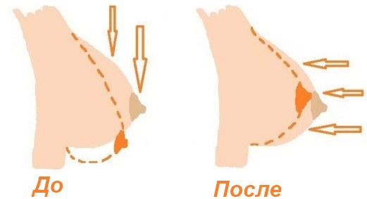 Mesothreads - lifting lifting en cosmétologie. Photos, avis, prix