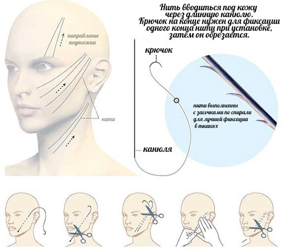 Des fils d'or pour un lifting. Quelle est cette procédure, photo, vidéo, prix, avis