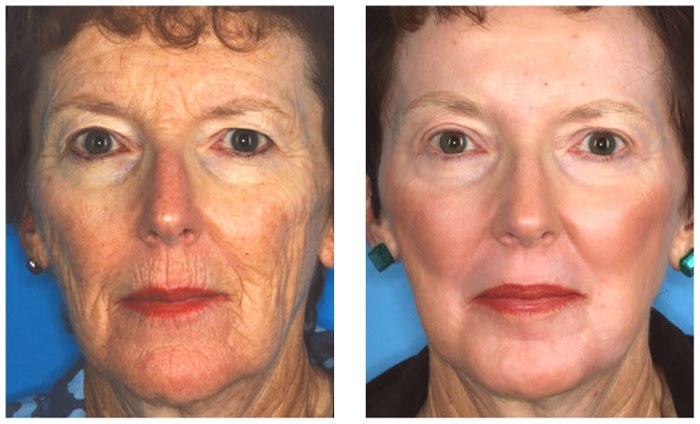 Qu'est-ce que le peeling chimique du visage