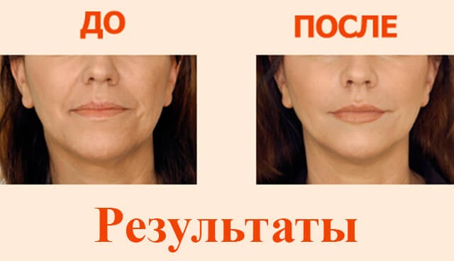 Contour des lèvres - une technique d'augmentation avec de l'acide hyaluronique, des charges. Photos et tarifs