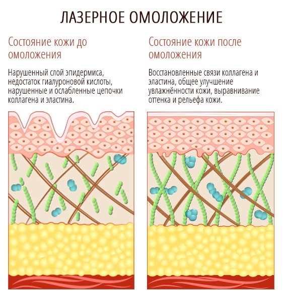 Resurfaçage au laser de la peau du visage à partir de cicatrices et de cicatrices. Photos avant et après, prix, avis. Soins de la peau à domicile après la procédure