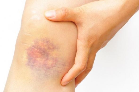 Shugaring ที่บ้าน วิธีกำจัดขนขาและบริเวณบิกินี่ สูตรวางน้ำตาลคำแนะนำเกี่ยวกับภาพถ่าย