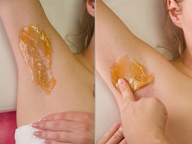 Shugaring ที่บ้าน วิธีกำจัดขนขาและบริเวณบิกินี่ สูตรวางน้ำตาลคำแนะนำเกี่ยวกับภาพถ่าย