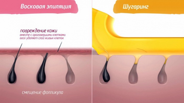 Shugaring ที่บ้าน วิธีกำจัดขนขาและบริเวณบิกินี่ สูตรวางน้ำตาลคำแนะนำเกี่ยวกับภาพถ่าย