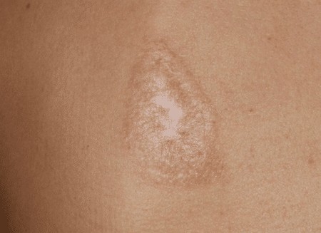 Cicatrices chéloïdes après la chirurgie - qu'est-ce que c'est et pourquoi sont-elles dangereuses? À quoi ressemblent les cicatrices chéloïdes. Une photo