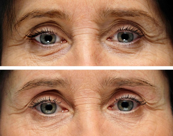 Acide hyaluronique pour le visage: mode de réalisation des injections, résultats, photos avant et après les injections, avis