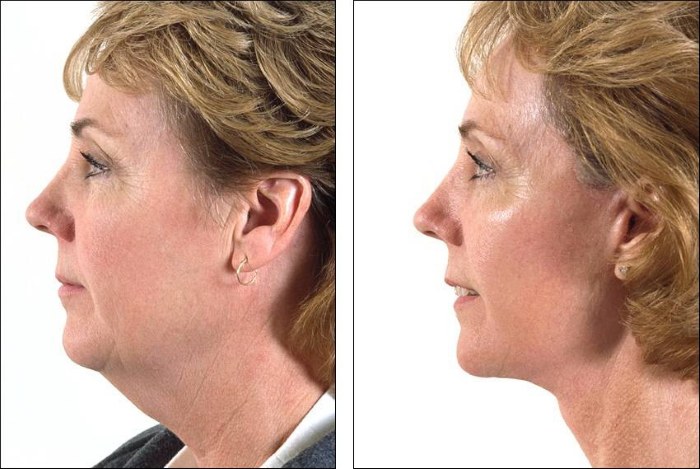 การปรับโฉมรูปไข่ - การยก, ครีมบำรุงผิว, กระทู้, มาสก์, การออกกำลังกายที่บ้าน รูปภาพ