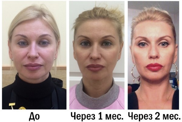 การปรับโฉมรูปไข่ - การยก, ครีมบำรุงผิว, กระทู้, มาสก์, การออกกำลังกายที่บ้าน รูปภาพ