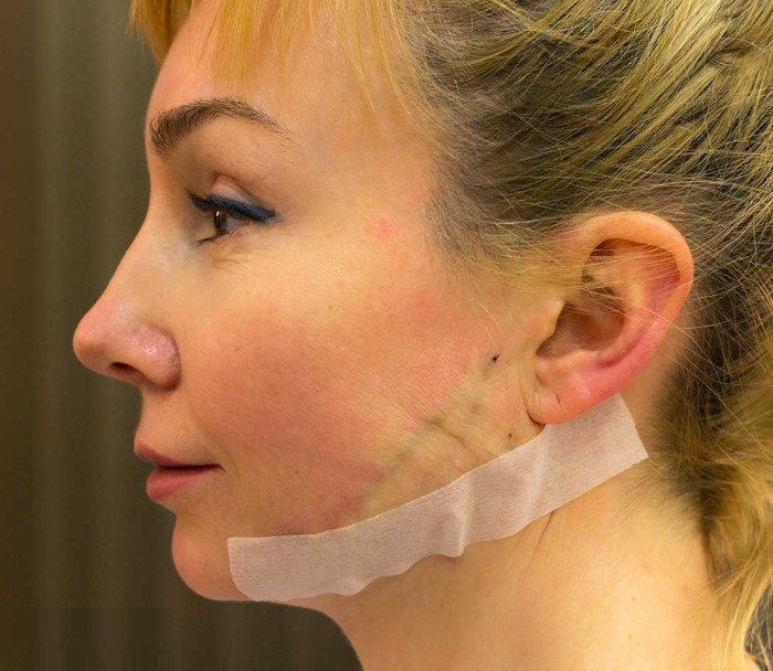 การปรับโฉมรูปไข่ - การยก, ครีมบำรุงผิว, กระทู้, มาสก์, การออกกำลังกายที่บ้าน รูปภาพ