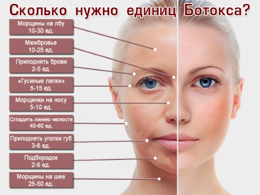 Anatomie des muscles faciaux humains en cosmétologie pour les injections de botox. Schémas avec descriptions et photos en latin et en russe
