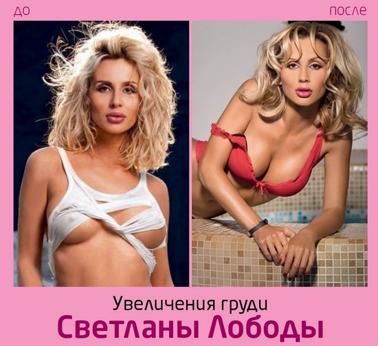 Svetlana Loboda ก่อนและหลังการทำศัลยกรรม ภาพถ่ายใบหน้าจมูกริมฝีปากหน้าอก ชีวประวัตินักร้องอายุพารามิเตอร์รูปร่างส่วนสูงและน้ำหนัก