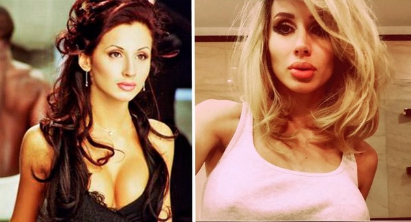 Svetlana Loboda ก่อนและหลังการทำศัลยกรรม ภาพถ่ายใบหน้าจมูกริมฝีปากหน้าอก ชีวประวัตินักร้องอายุพารามิเตอร์รูปร่างส่วนสูงและน้ำหนัก
