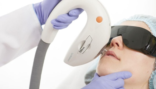 Appareil pour éliminer les taches de vieillesse, les cicatrices, les tatouages sur le visage et la peau du corps. Laser, Fraxel, Elos, M22. Note et avis