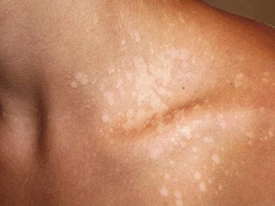 Chélidoine. Instructions d'utilisation et contre-indications. Traitement des verrues sur les mains, la plante des pieds, du cancer, des papillomes. Avis des dermatologues