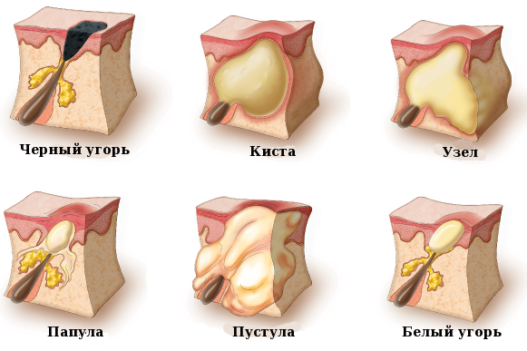 Peeling Ferul - qu'est-ce que c'est, comment est-il fait, acides, protocole de la procédure Medderma, critiques, photos et résultats