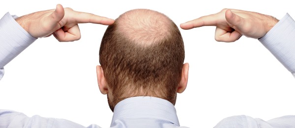 Méthodes de greffe de cheveux du cuir chevelu pour hommes et femmes. Comment se déroule l'opération, HFE, prix des cliniques, résultats, photos