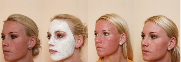 Avantages et inconvénients du peeling du visage: chimique, acides de fruits, glycolique, matériel, rétinol, Jessner, acide succinique, avec du calcium