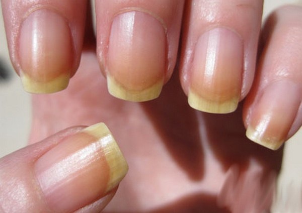 Comment renforcer les ongles pour qu'ils ne s'exfolient pas et ne se cassent pas à la maison La raison de la fragilité, comment traiter