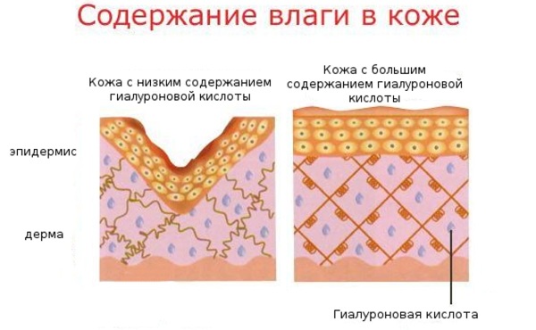 Remplisseurs dans les nasolabiaux. Avis, photos avant et après correction. L'efficacité de la procédure, les conséquences et les complications possibles
