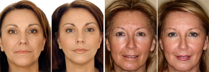 Solcoseryl pour le visage contre les rides: avis des cosmétologues, quel est le meilleur gel ou pommade, comment utiliser à la maison