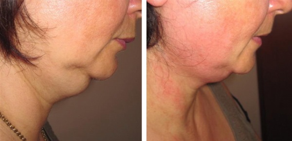 Aqualyx. Avis, photos avant et après. Composition, utilisation en intralipothérapie. Prix du prix d'une injection d'un médicament lipolytique, analogues