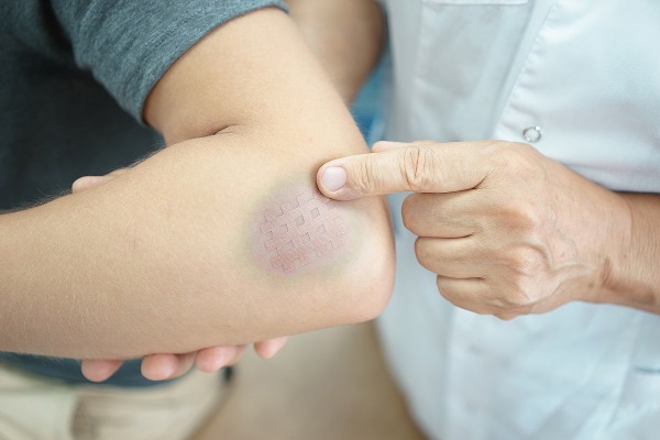 Pommade à l'arnica. Instructions d'utilisation en cosmétologie pour le visage, des rides, avec lactostase. Prix, analogues