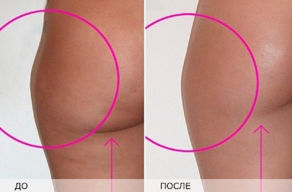 Comment se débarrasser de la cellulite sur les jambes à la maison: rapidement, après l'accouchement, derrière, sur les mollets. Exercice, enveloppements, massage, régime