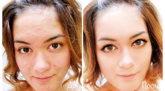 Gel métrogyl acné. Avis des médecins et des acheteurs, composition, efficacité, mode d'emploi