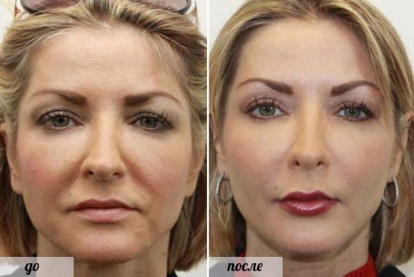 Chirurgie plastique faciale.Photos avant et après la chirurgie de contouring à l'acide hyaluronique. Prix, avis