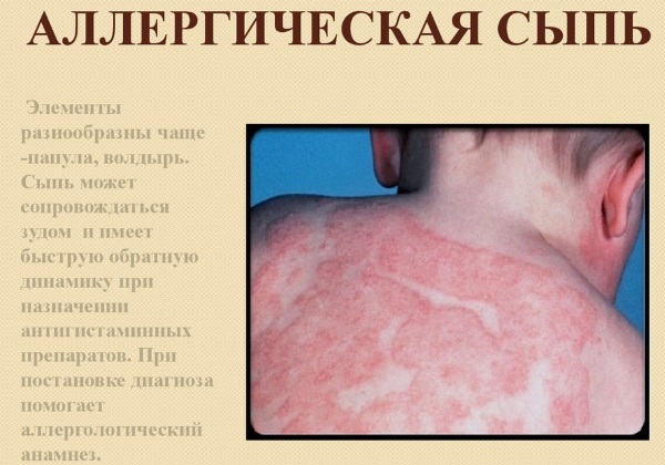 Acné sur les épaules, la poitrine, le dos, le décolleté d'une femme.Raisons pour traiter à la maison