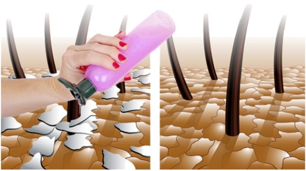 แชมพูขจัดรังแค คะแนนที่ดีที่สุดในร้านขายยาสำหรับผมแห้งและมัน: Vichy, Ketoconazole, Sebazol, Sulsena