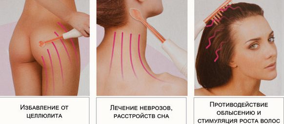 Darsonvalization - qu'est-ce que c'est en cosmétologie, les avantages de la procédure pour la peau du visage, de la tête, des paupières, des cheveux, des appareils. Indications et contre-indications, efficacité