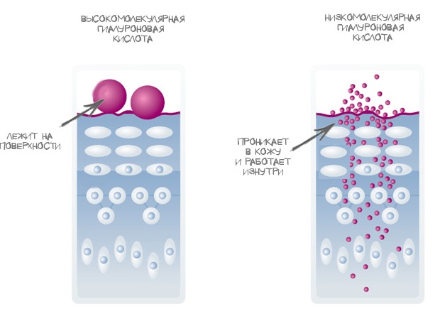 Acide hyaluronique pour les lèvres: photos avant et après, avantages et inconvénients, effet, contre-indications. Prix de la procédure et avis