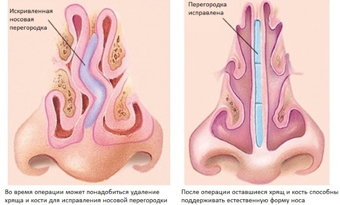 Courbure de la cloison nasale. Symptômes, causes et conséquences. Opération de septoplastie: indications, contre-indications, types et caractéristiques