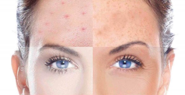 Comment déterminer le type de peau du visage: grasse, sèche, mixte, normale. Caractéristiques de la détermination du phototype Fitzpatrick, du sous-ton, du type de couleur