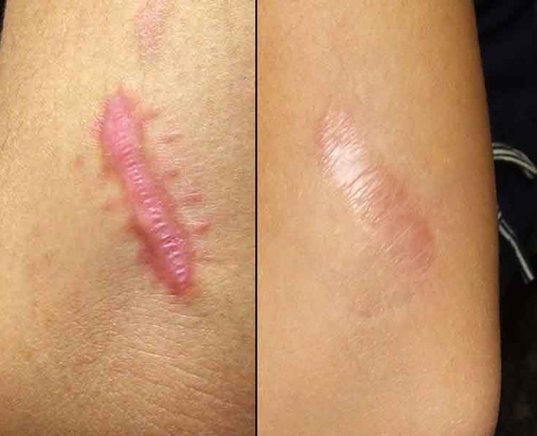 Huile de ricin pour le visage: pour les rides, les taches de vieillesse, l'acné. Application pour peeling, peau sèche et grasse, démodécie, pendant la grossesse