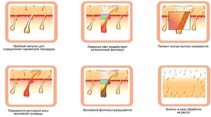 Épilation au laser sur le visage, dans la zone du bikini, les jambes pour toujours. Prix, appareils à retirer à domicile. Une photo