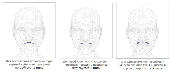 Augmentation des lèvres avec de l'acide hyaluronique, des charges, du botox, du silicone, des plastiques de contour. Photo, prix, avis